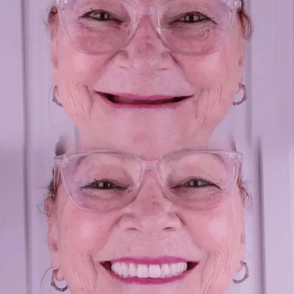Antes e depois de reabilitação com implantes, caso 1, Santo André