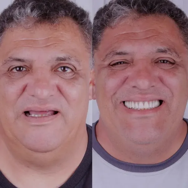 Antes e depois de reabilitação com implantes, caso 2, Santo André