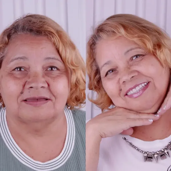 Antes e depois de reabilitação com implantes, caso 3, Santo André