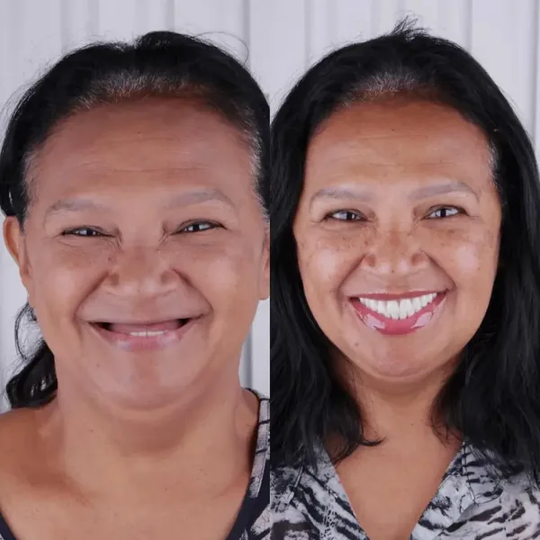 Antes e depois de reabilitação com implantes, caso 4, Santo André