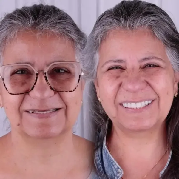 Antes e depois de reabilitação com implantes, caso 5, Santo André