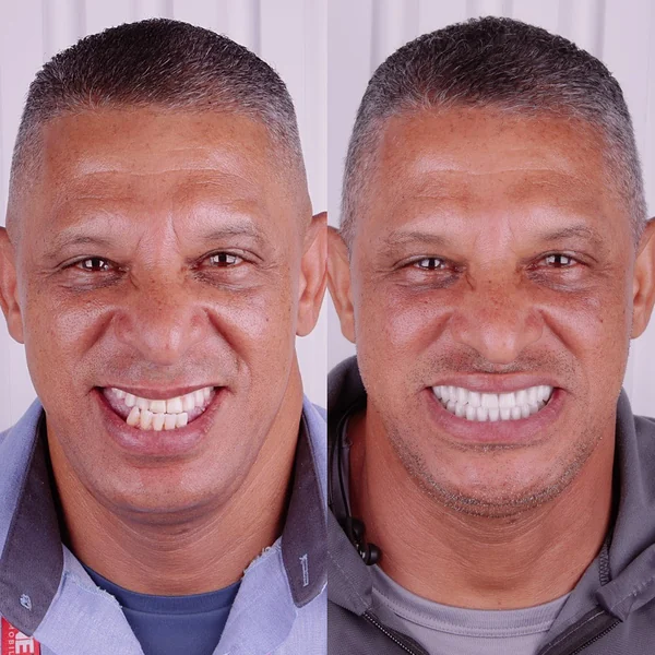 Antes e depois de reabilitação com implantes, caso 6, Santo André