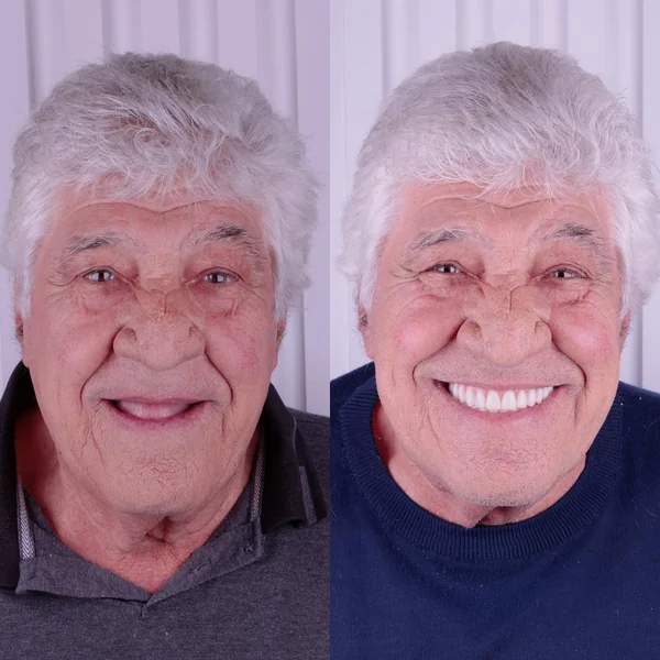 Antes e depois de reabilitação com implantes, caso 7, Santo André
