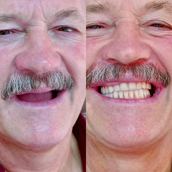 Antes e depois de reabilitação com implantes, caso 8, Santo André