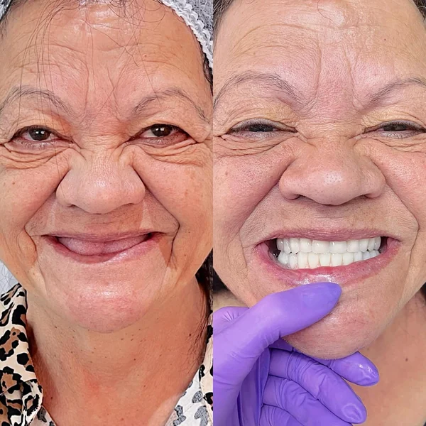 Antes e depois de reabilitação com implantes, caso 9, Santo André